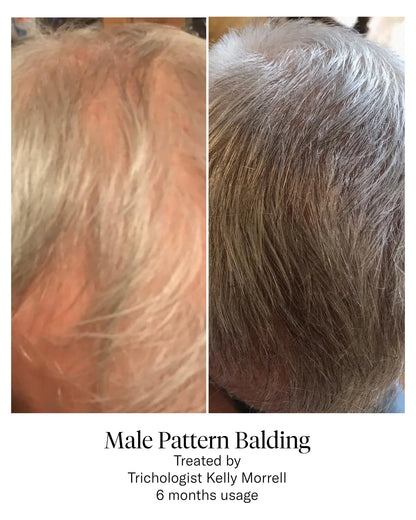 Calecim Professional - Advanced Hair System